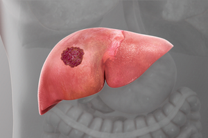 Cancer Surveillance