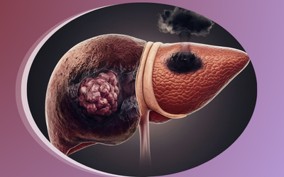Liver Cancer and HPB